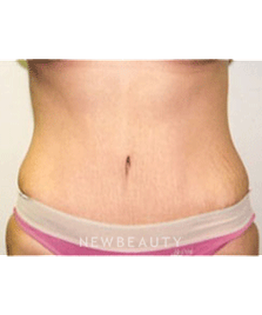 dr-sanjay-grover-tummy-tuck-b