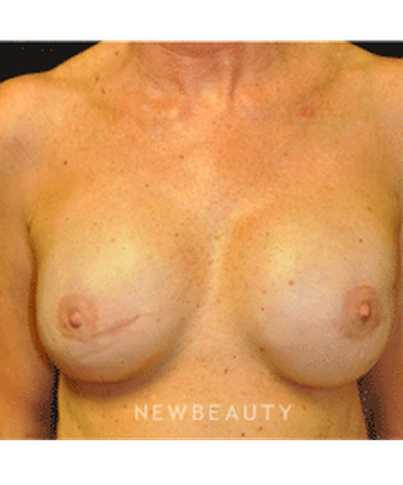 dr-andrew-smith-breast-reconstruction-b
