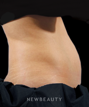dr-marina-peredo-coolsculpting-b
