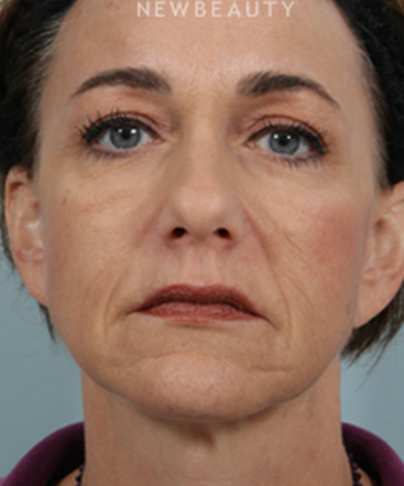 dr-kenneth-beer-liquid-facelift-b