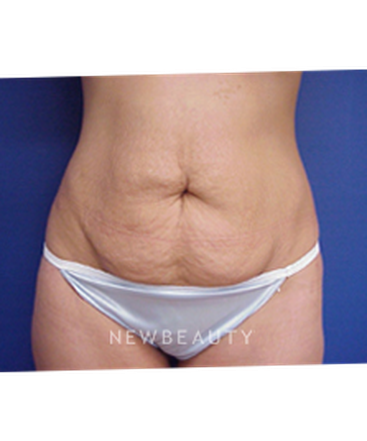 dr-joseph-russo-tummy-tuck-b