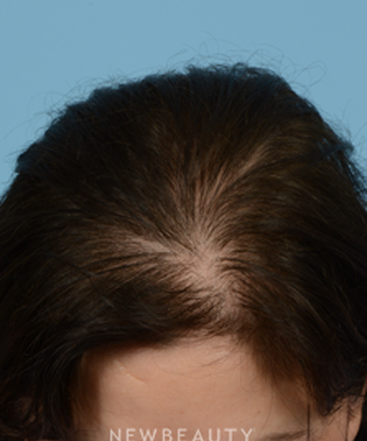 dr-jeffrey-wise-hair-loss-treatment-b