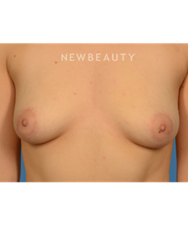 dr-bryan-gawley-breast-augmentation-b