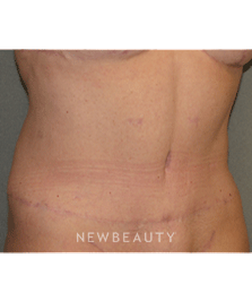dr-sean-simon-tummy-tuck-lipo-b