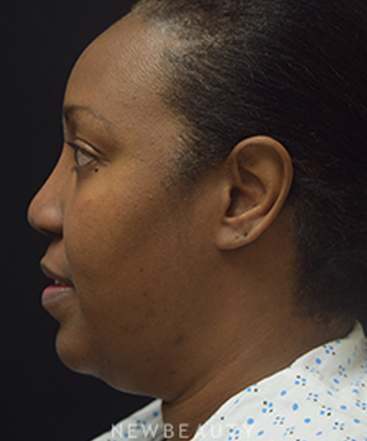 dr-jeffrey-b-wise-lipo-rhinoplasty-b