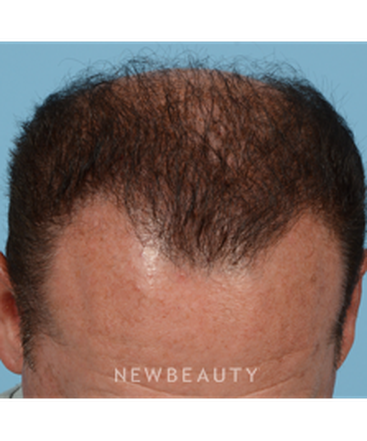 dr-jeffrey-wise-hair-loss-treatment-b