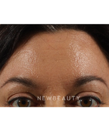 dr-marina-peredo-botox-b