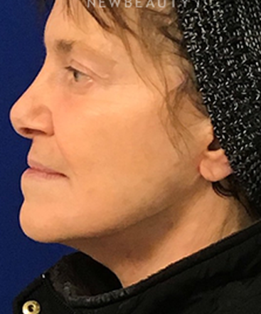 dr-dilip-madnani-facial-rejuvenation-b