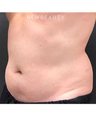 dr-janet-allenby-coolsculpting-b