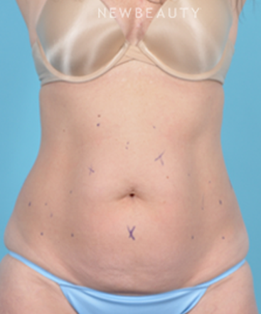 dr-bradley-bengtson-coolsculpting-b