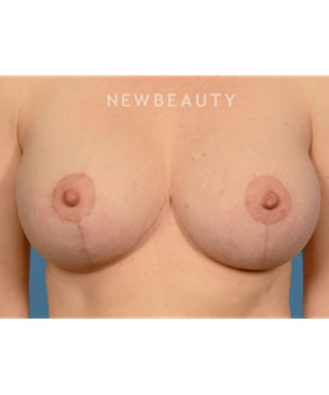 dr-bryan-gawley-breast-augmentation-b