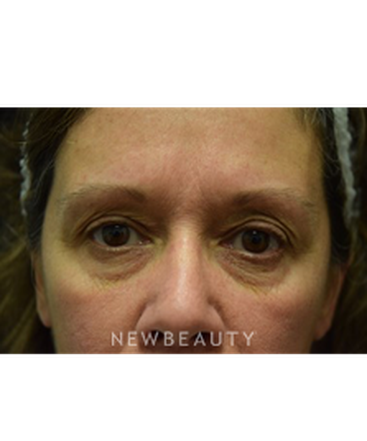 dr-jeffrey-b-wise-blepharoplasty-b