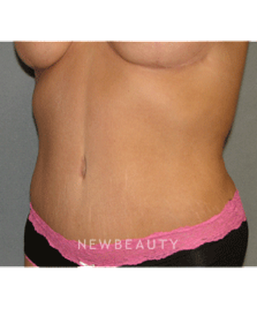 dr-sean-simon-tummy-tuck-lipo-b