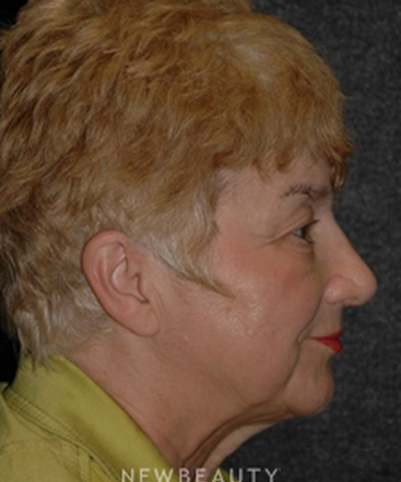 dr-ryan-chastant-rhinoplasty-b