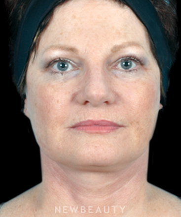dr-bradley-bengtson-facial-rejuvenation-b