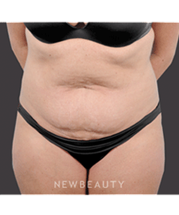 dr-bradley-bengtson-liposuction-tummy-tuck-b