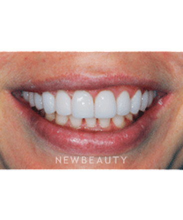 dr-ronald-goldstein-smile-makeover-crowns-whitening-gum-lift-contouring-b