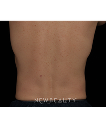 dr-jennifer-segal-coolsculpting-b