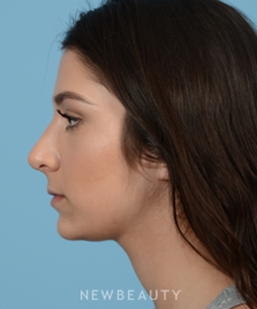 dr-jeffrey-b-wise-rhinoplasty-b