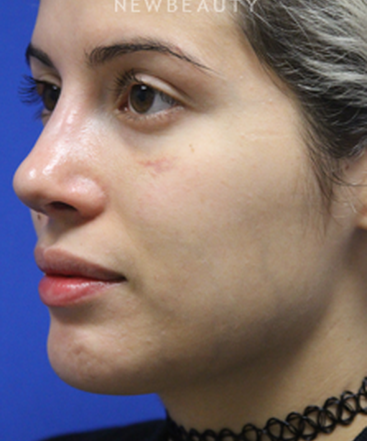 dr-jennifer-levine-rhinoplasty-b