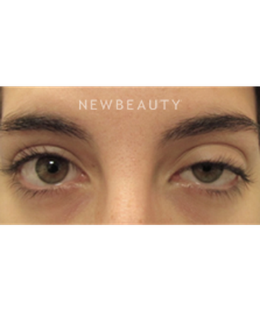 dr-raymond-douglas-upper-blepharoplasty-b