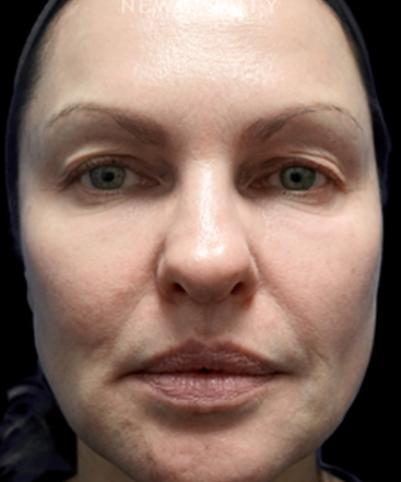 dr-niki-christopoulos-upper-blepharoplasty-b