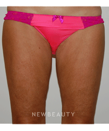 dr-david-p-rapaport-coolsculpting-b