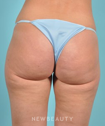 dr-brad-bengtson-cellulite-treatment-b