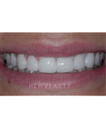 dr-guy-lewis-veneers-b