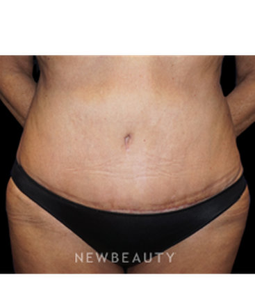 dr-niki-a-christopoulos-tummy-tuck-with-liposuction-b
