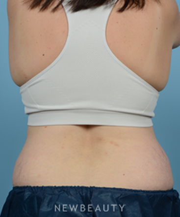 dr-jeffrey-wise-coolsculpting-b