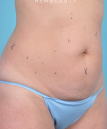 dr-bradley-bengtson-coolsculpting-b