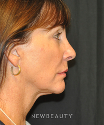 dr-andrew-smith-facelift-b