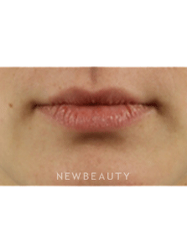 dr-marina-peredo-lip-augmentation-b