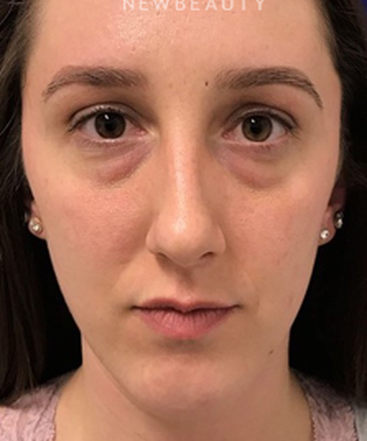 dr-dilip-madnani-lower-blepharoplasty-b