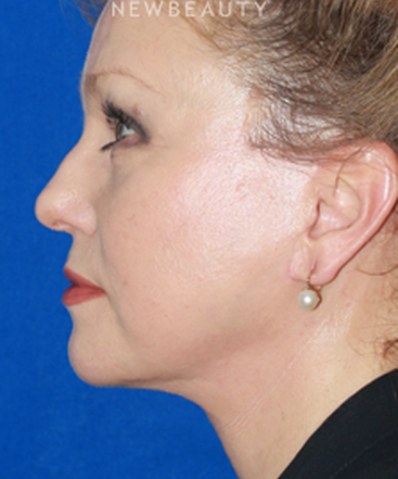 dr-konstantin-vasyukevich-facelift-b
