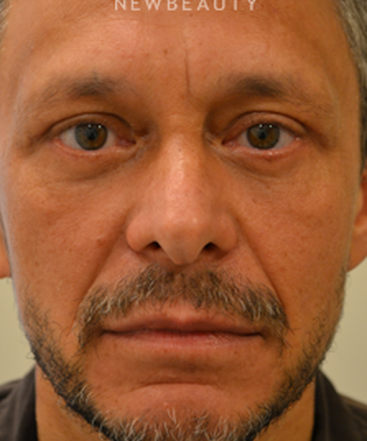 dr-bajeet-purewal-upper-and-lower-blepharoplasty-b