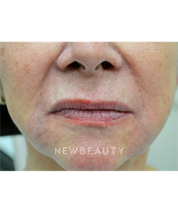 dr-baljeet-purewal-liquid-facelift-b