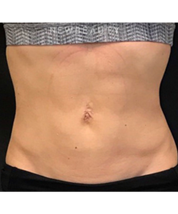 dr-janet-allenby-emsculpt-b