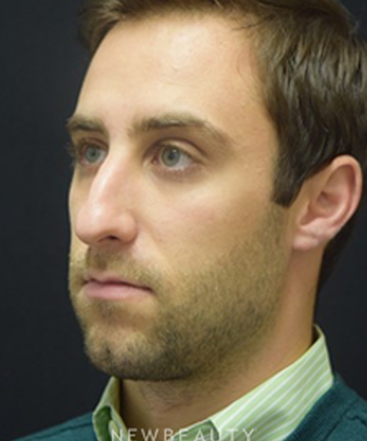 dr-jeffrey-b-wise-rhinoplasty-b