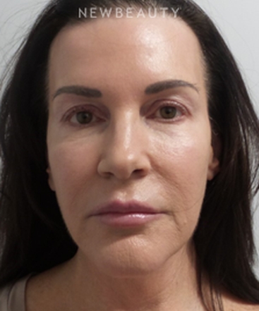 dr-marina-peredo-facelift-b