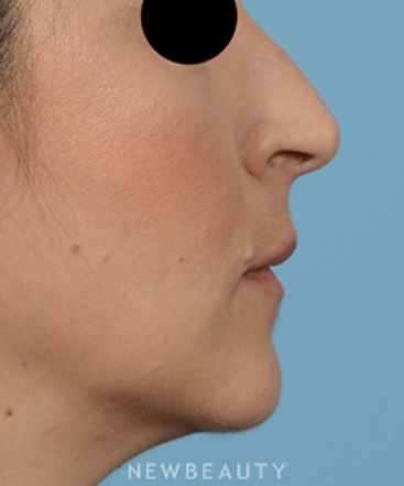 dr-jeffrey-b-wise-rhinoplasty-b