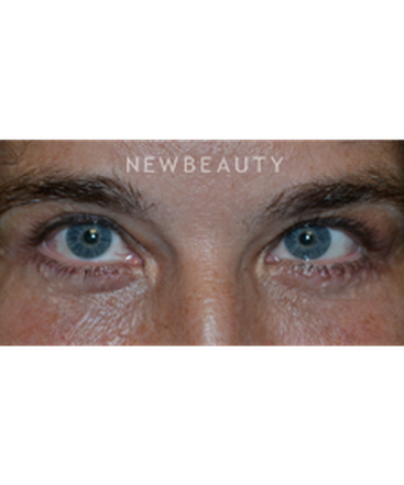 dr-baljeet-k-purewal-blepharoplasties-b