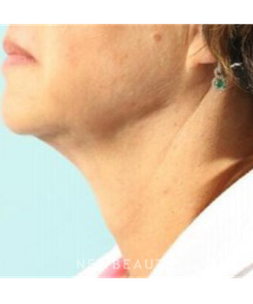 dr-marina-peredo-necklift-b
