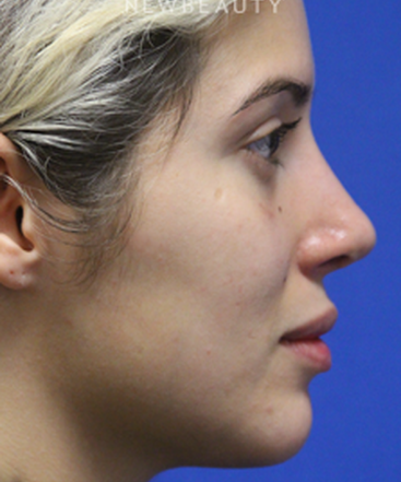 dr-jennifer-levine-rhinoplasty-b