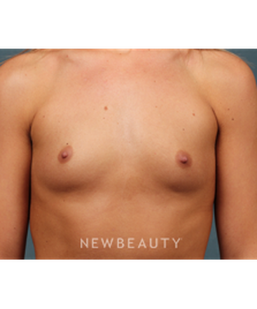 dr-m-bradley-calobrace-breast-augmentation-b