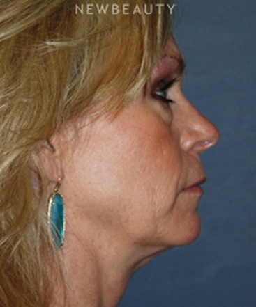 dr-brent-smith-refreshed-results-b