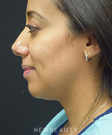 dr-jeffrey-b-wise-kybella-b