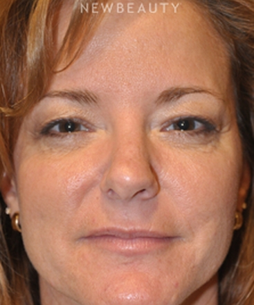 dr-bryan-w-gawley-revision-rhinoplasty-b