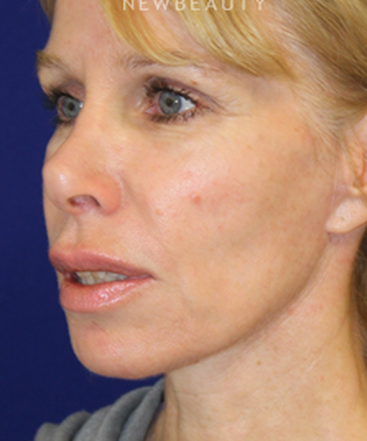dr-dilip-madnani-mini-facelift-b